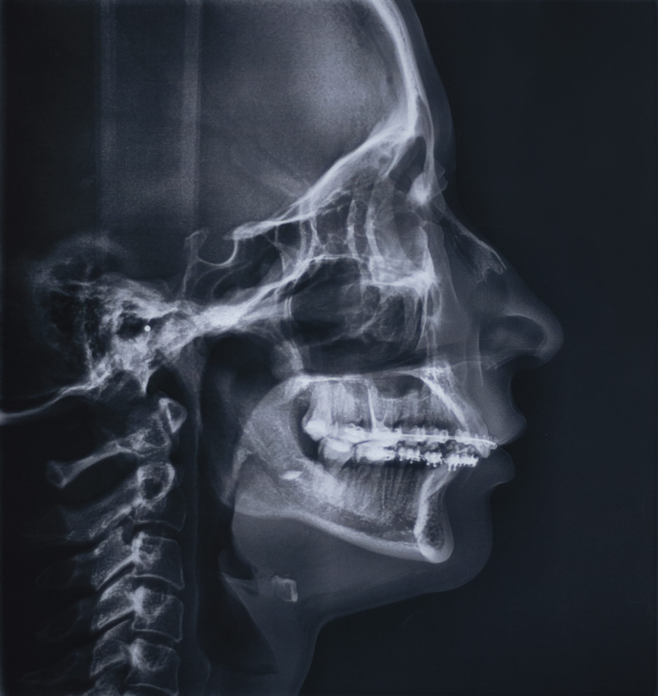 Radiographic Cephalometry 歯科　本　矯正 Radiographic Cephalometry 歯科 本 矯正 本